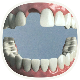 Implantat - bei einem fehlenden Zahn - vor
