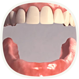 Implantat - bei komplett fehlenden Zähnen - vor