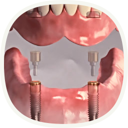 implantátum - teljes foghiány esetén - közben