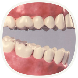 Implantat - bei mehreren fehlenden Zähnen - nach